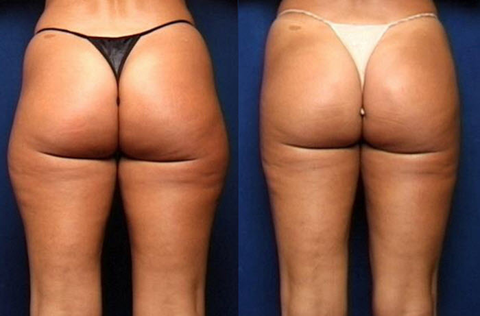 liposuction