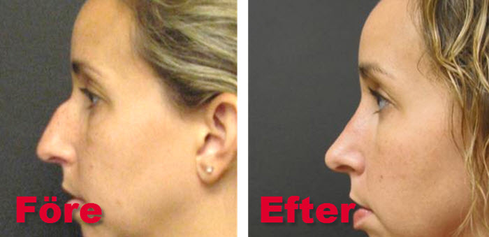 rhinoplasty