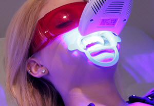 laser blekning av tänderna