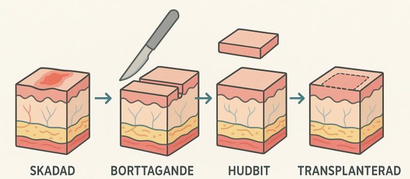 Förstå processen bakom hudtransplantation